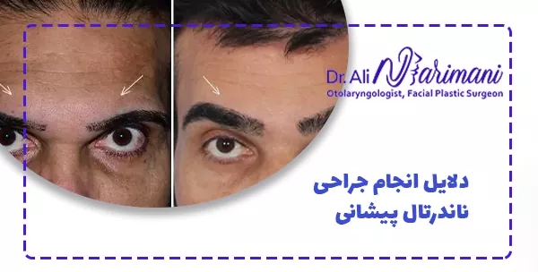 دلایل انجام جراحی ناندرتال پیشانی