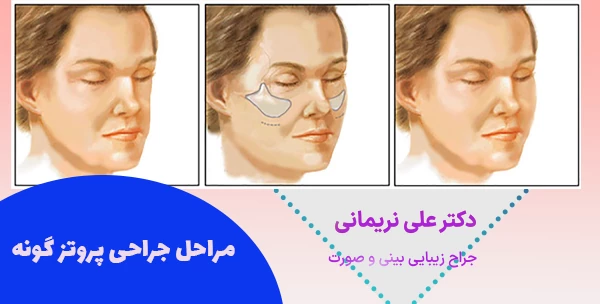 مراحل جراحی پروتز گونه