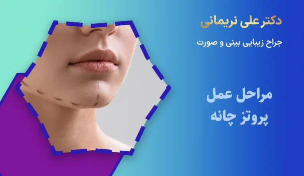مراحل عمل پروتز چانه