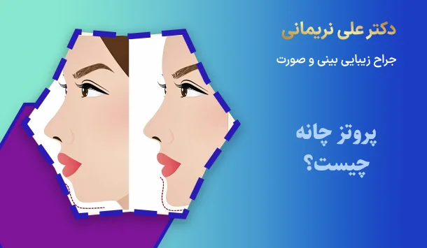 پروتز چانه چیست؟