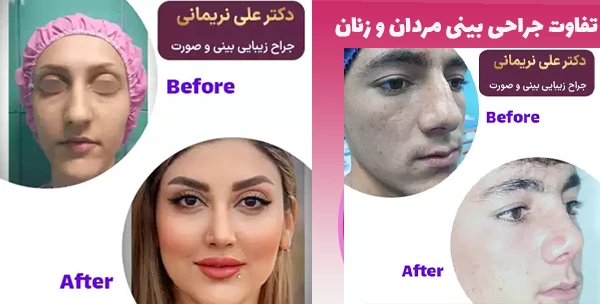 تفاوت جراحی بینی مردان و زنان