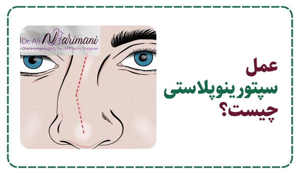عمل سپتورینوپلاستی چیست؟
