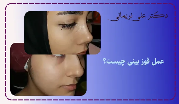 عمل قوز بینی چیست؟