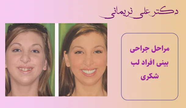 مراحل جراحی بینی افراد لب شکری