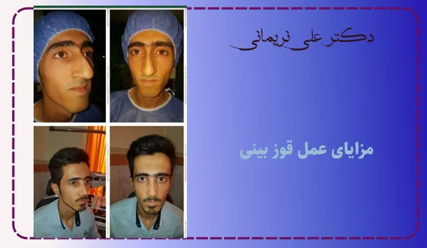 مزایای عمل قوز بینی
