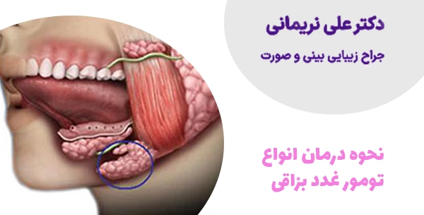 نحوه درمان انواع تومور غدد بزاقی