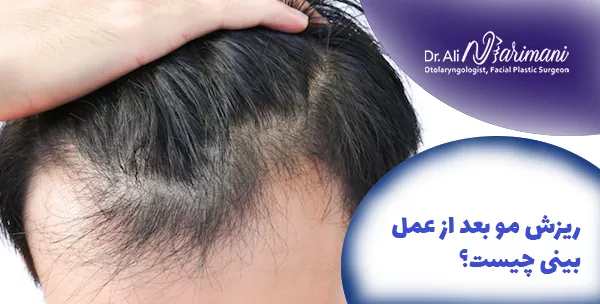 ریزش مو بعد از عمل بینی چیست؟