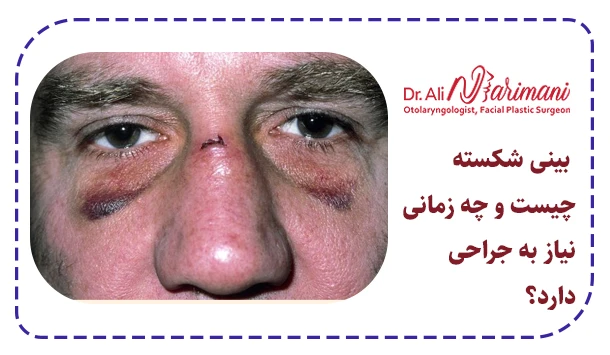 بینی شکسته چیست و چه زمانی نیاز به جراحی دارد؟