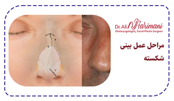 مراحل عمل بینی شکسته