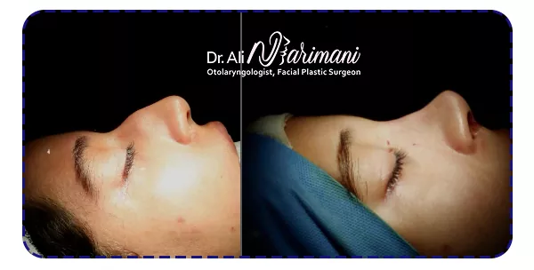 جراحی بینی استخوانی نمونه جراحی بینی استخوانی نمونه