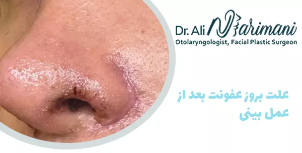 علت بروز عفونت بعد از عمل بینی