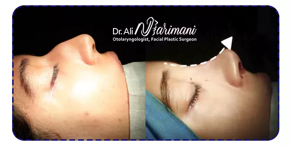 نمونه جراحی بینی استخوانی نمونه جراحی بینی استخوانی