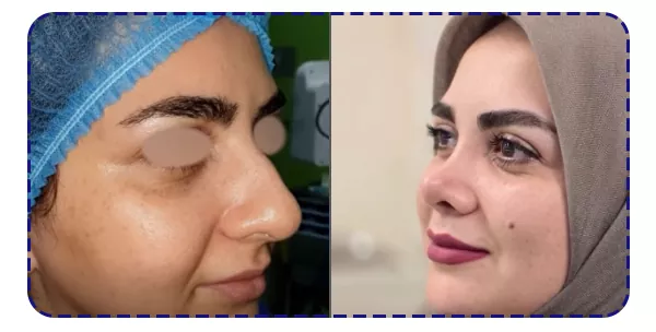 نمونه جراحی بینی گوشتی نمونه جراحی بینی گوشتی