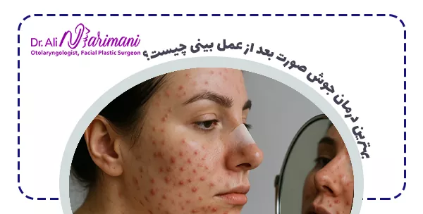 بهترین درمان جوش صورت بعد از عمل بینی چیست؟