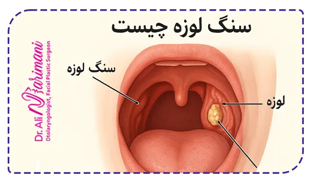 سنگ لوزه چیست سنگ لوزه چیست