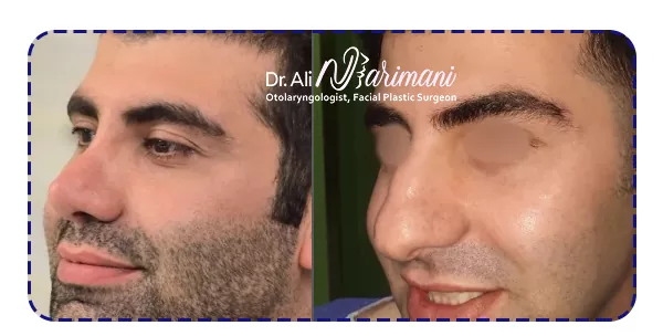 نمونه جراحی بینی نیمه فانتزی نمونه جراحی بینی نیمه فانتزی