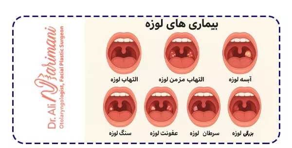 انواع بیماری های لوزه