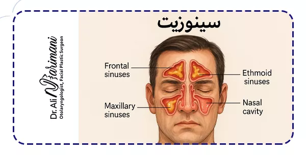 سینوزیت چیست؟