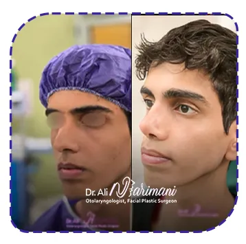 نمونه جراحی بینی دکتر نریمانی